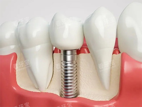 ��ֲ��ģ�ͽ���ͼ