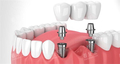 �ڿ�ǻ�ڽ�����ֲ��