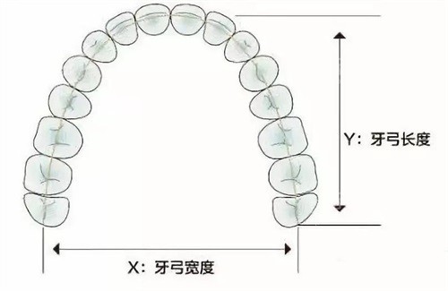 牙齿矫正扩牙弓示意图 牙齿矫正扩牙弓示意图