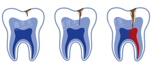 牙釉质牙齿龋坏不同程度 牙釉质牙齿龋坏不同程度