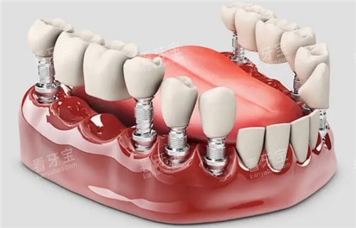 种植牙手术图 种植牙手术图