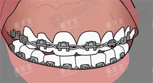 牙齿矫正动画图 牙齿矫正动画图