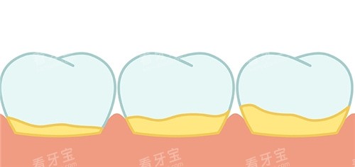 牙齿有牙结石 牙齿有牙结石