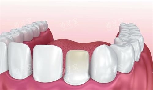 ȫ����Ӳ��800MPa��������900�����б�Ҫ����ҽ����ѡ���ʺϵ�Ӳ�ȣ�