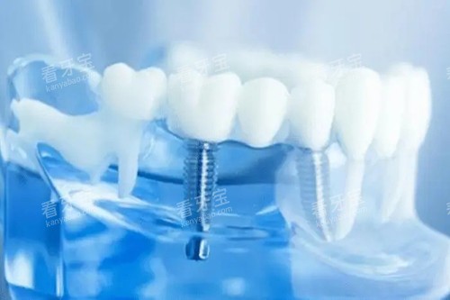 ��ֲ��ģ��ʾ��ͼ