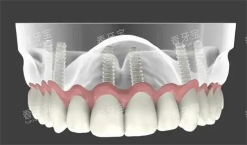 全口种植牙解析图 全口种植牙解析图