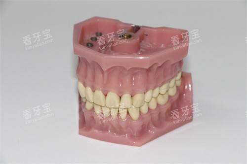 牙齿模型示意图 牙齿模型示意图