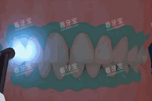 美白牙齿示意图 美白牙齿示意图