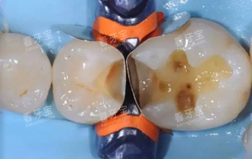 龋齿示意图 龋齿示意图