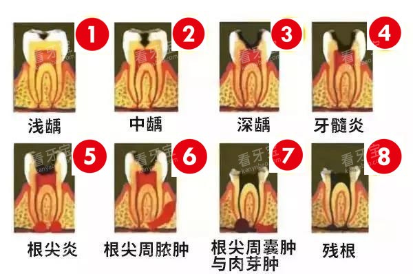 龋齿的情况 龋齿的情况