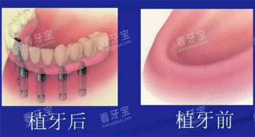 全口种植牙前后 全口种植牙前后
