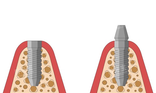 ��ֲ��׮��չʾ