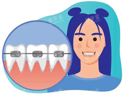 儿童牙齿矫正卡通图 儿童牙齿矫正卡通图