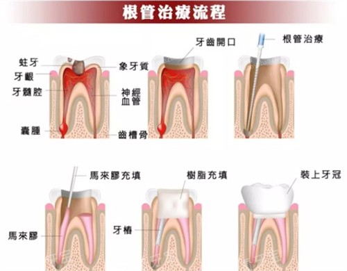 根管治疗流程 根管治疗流程