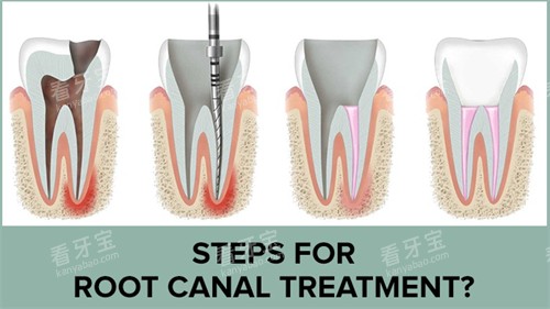 根管治疗手术过程 根管治疗手术过程