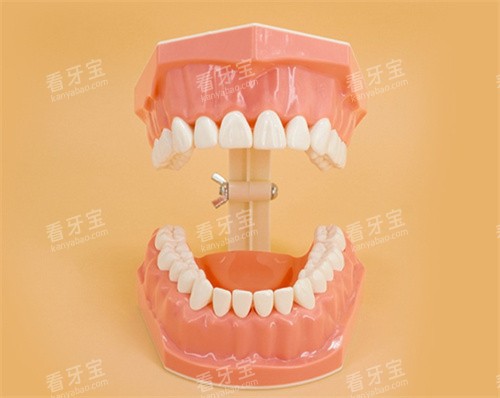 牙齿开口模型 牙齿开口模型