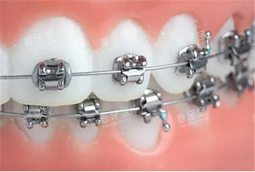 金属托槽矫正动画图示 金属托槽矫正动画图示