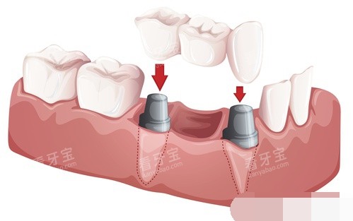 ������ֲ����װ������������ͼ