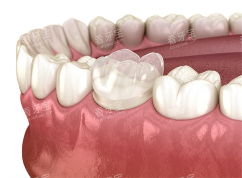 牙齿全瓷冠 牙齿全瓷冠