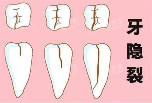 牙齿裂纹的程度 牙齿裂纹的程度