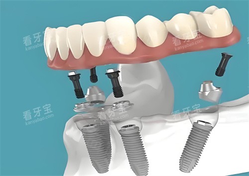 光华口腔医院2026收费价目表:种植牙5000元起、牙齿矫正9800元起、全瓷牙1580元起