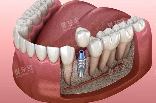 单颗种植牙解刨图 单颗种植牙解刨图
