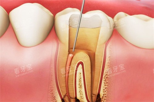 根管治疗牙神经图 根管治疗牙神经图