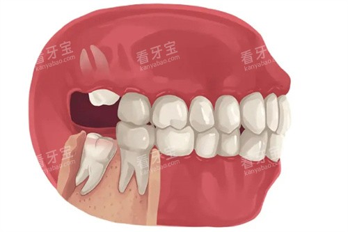 上下智齿萌出 上下智齿萌出