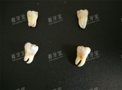 不同类型智齿实物展示图 不同类型智齿实物展示图