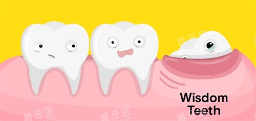 下颌智齿萌出 下颌智齿萌出