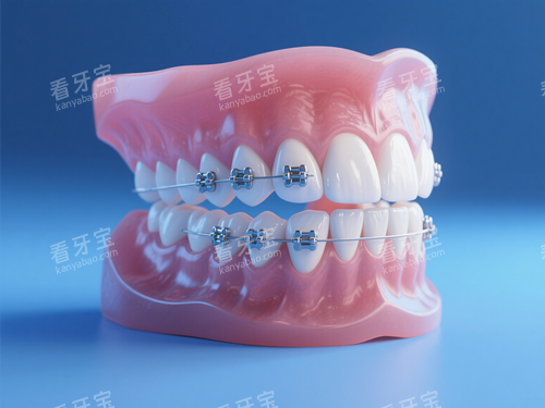金属托槽矫正模型 金属托槽矫正模型