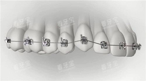 金属托槽矫正图示 金属托槽矫正图示