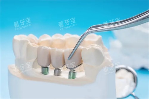 种植牙动画图展示 种植牙动画图展示