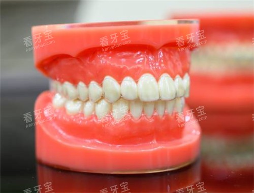 隐形矫正牙套佩戴模型展示图 隐形矫正牙套佩戴模型展示图