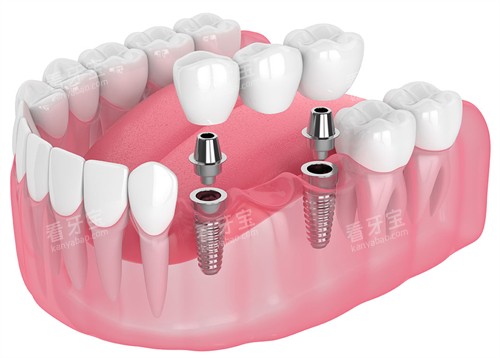 种植牙的构成 种植牙的构成