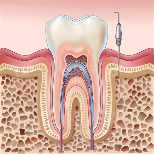 牙齿根管治疗漫画示意图 牙齿根管治疗漫画示意图