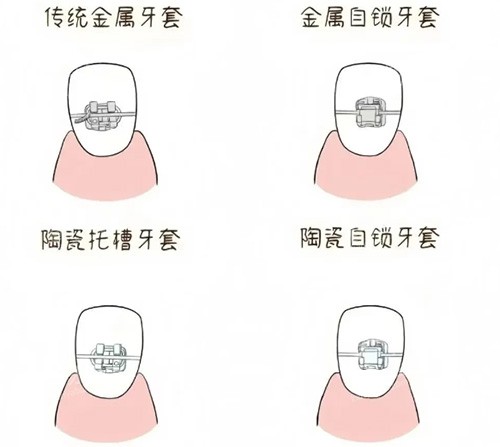 牙套品牌种类示意图 牙套品牌种类示意图
