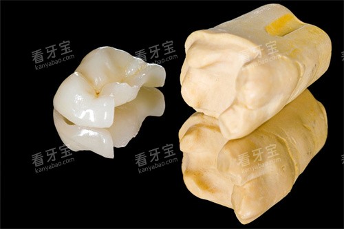 全瓷嵌体 全瓷嵌体