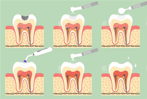 补牙步骤图 补牙步骤图
