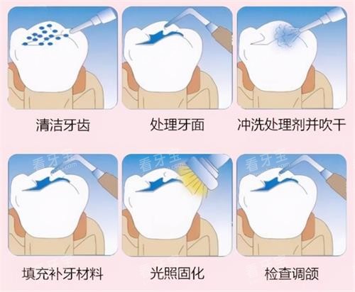 补牙的过程 补牙的过程