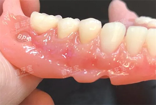BPS吸附性义齿成品 BPS吸附性义齿成品