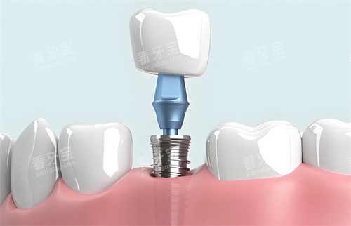 种植牙模型结构图片 种植牙模型结构图片