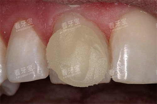 牙齿上的树脂 牙齿上的树脂