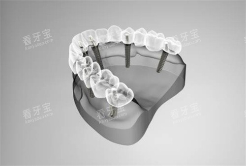 2026�ݲ���ǻ��/ȫ����ֲ���Żݼ۸�ALL-ON-4������ȫ����ʡ����Ǯ��