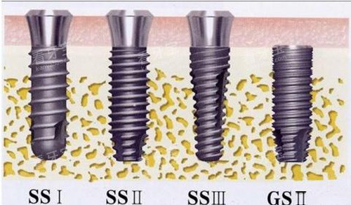 奥齿泰植体示意图 奥齿泰植体示意图