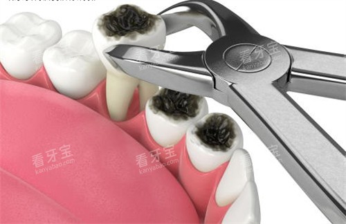 坏牙拔除 坏牙拔除