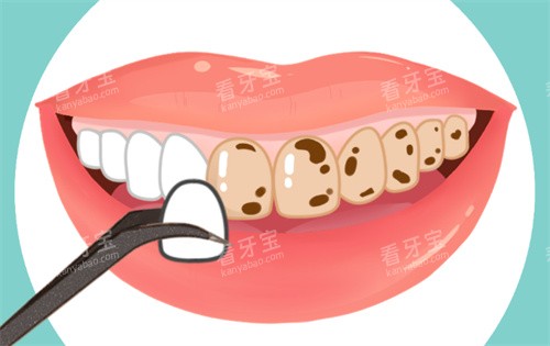 牙齿贴面动画图 牙齿贴面动画图