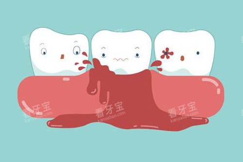 牙齿出血示意图 牙齿出血示意图