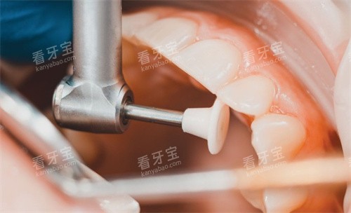 牙齿检查修复操作图 牙齿检查修复操作图