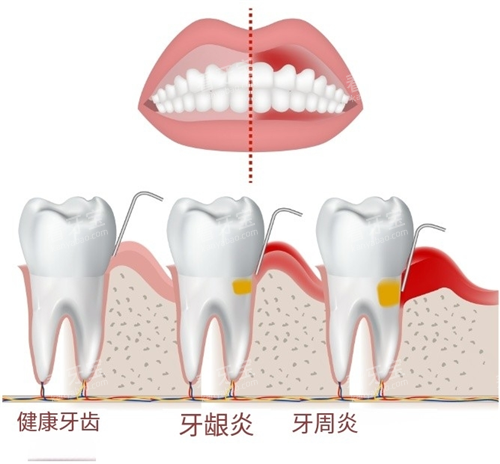 健康牙齿和牙龈炎 健康牙齿和牙龈炎